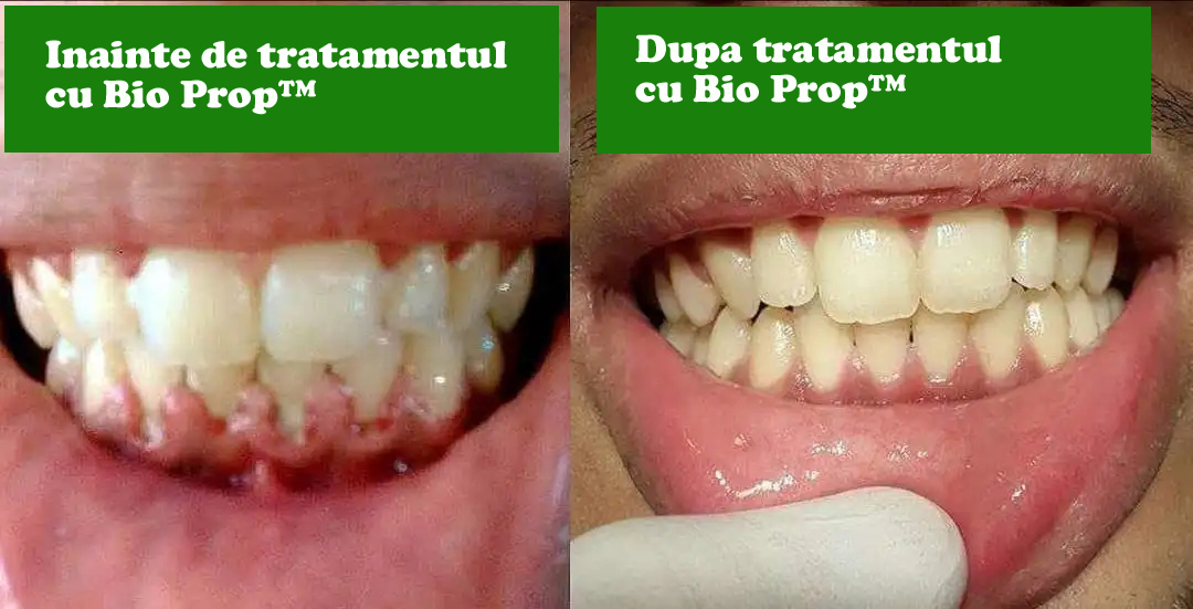 tratament naturist paradontoza